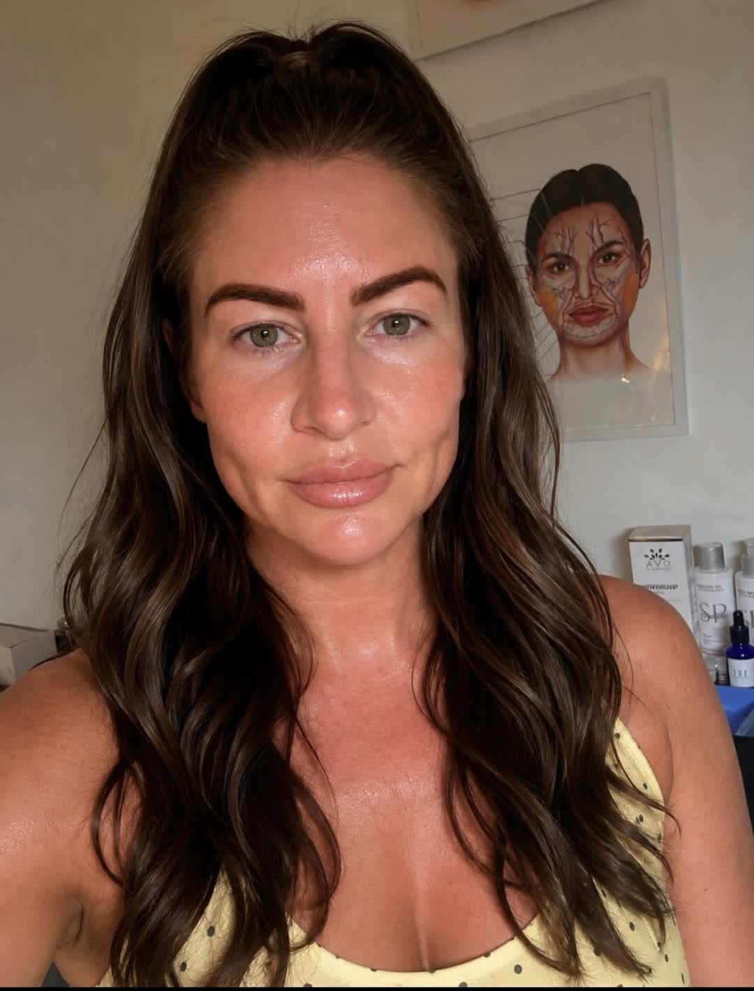 Glowing skin after microneedling and skin booster treatment in Macclesfield